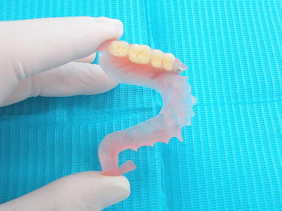 ノンクラスプデンチャー